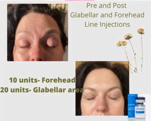 Botox Before & After
