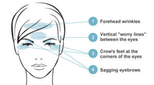 Botox Chart