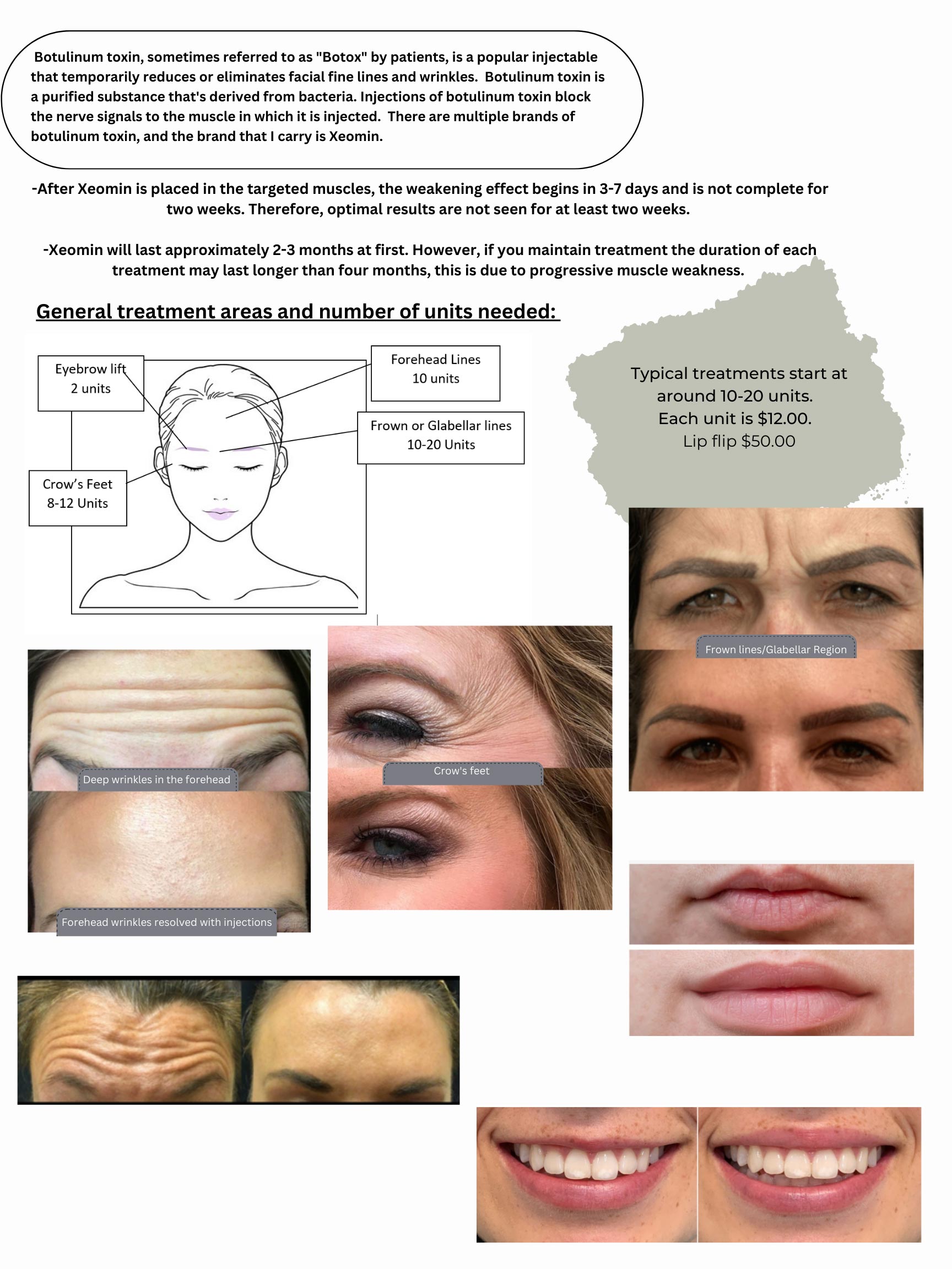 Botox Chart - Urban Village SalonSpa